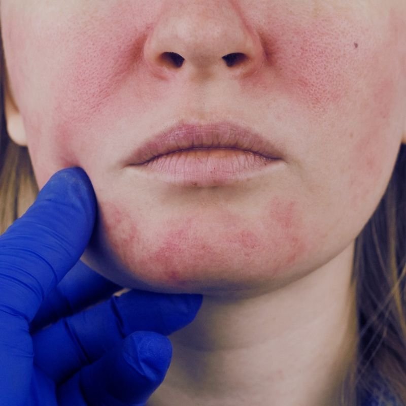 Close-up of a woman's face showing red skin irritation on her cheeks and chin, with a person's gloved hand gently touching her chin.