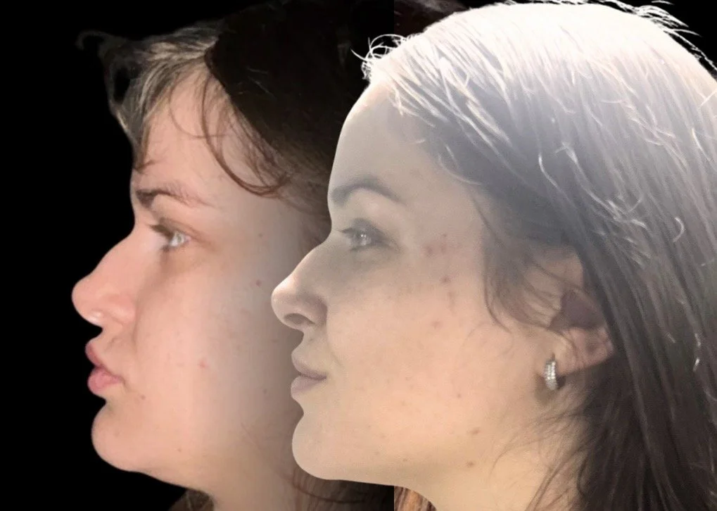 Why Your Deep Bite Needs Vertical Height — And Why Palate Expansion Is the Wrong First Step