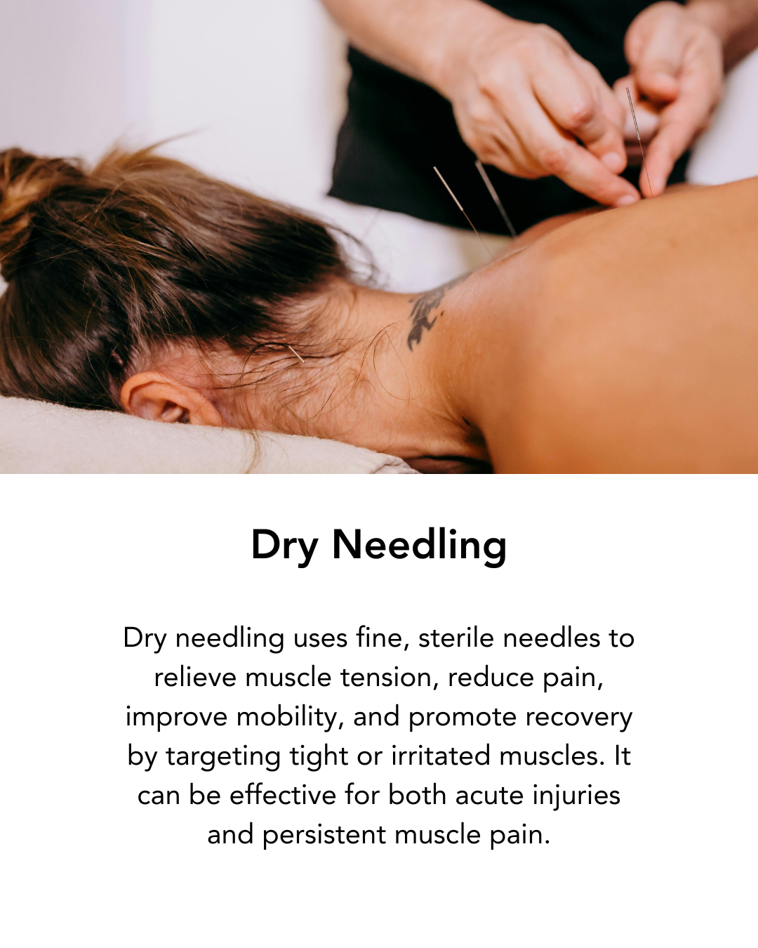 A person receiving dry needling therapy on their back while lying face down on a treatment table, with a therapist inserting fine needles into their shoulder muscles.