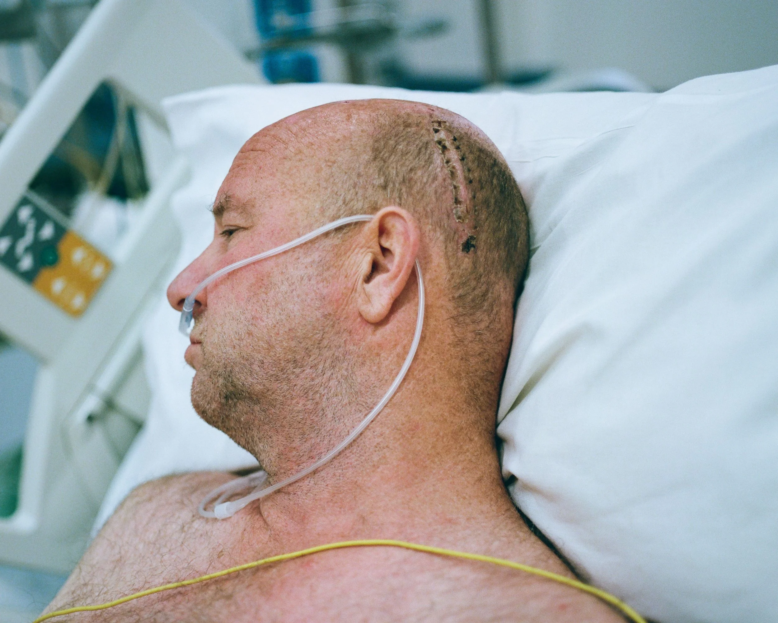 A man lying in a hospital bed with a surgical scar on the top of his head, wearing a nasal oxygen tube.