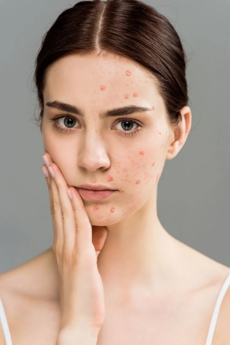 Holistic Anti-Acne