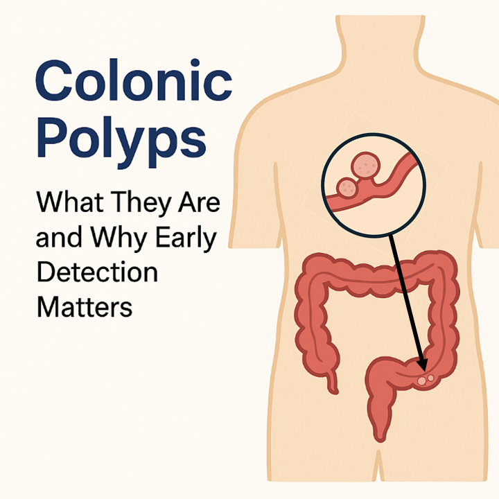 Colonic Polyps: What They Are and Why Early Detection Matters