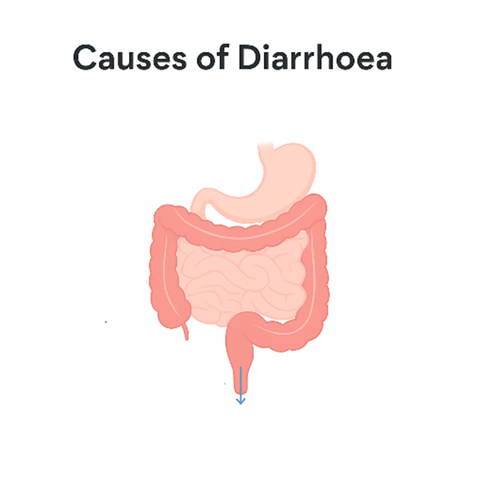 Understanding Diarrhoea: Causes and Management
