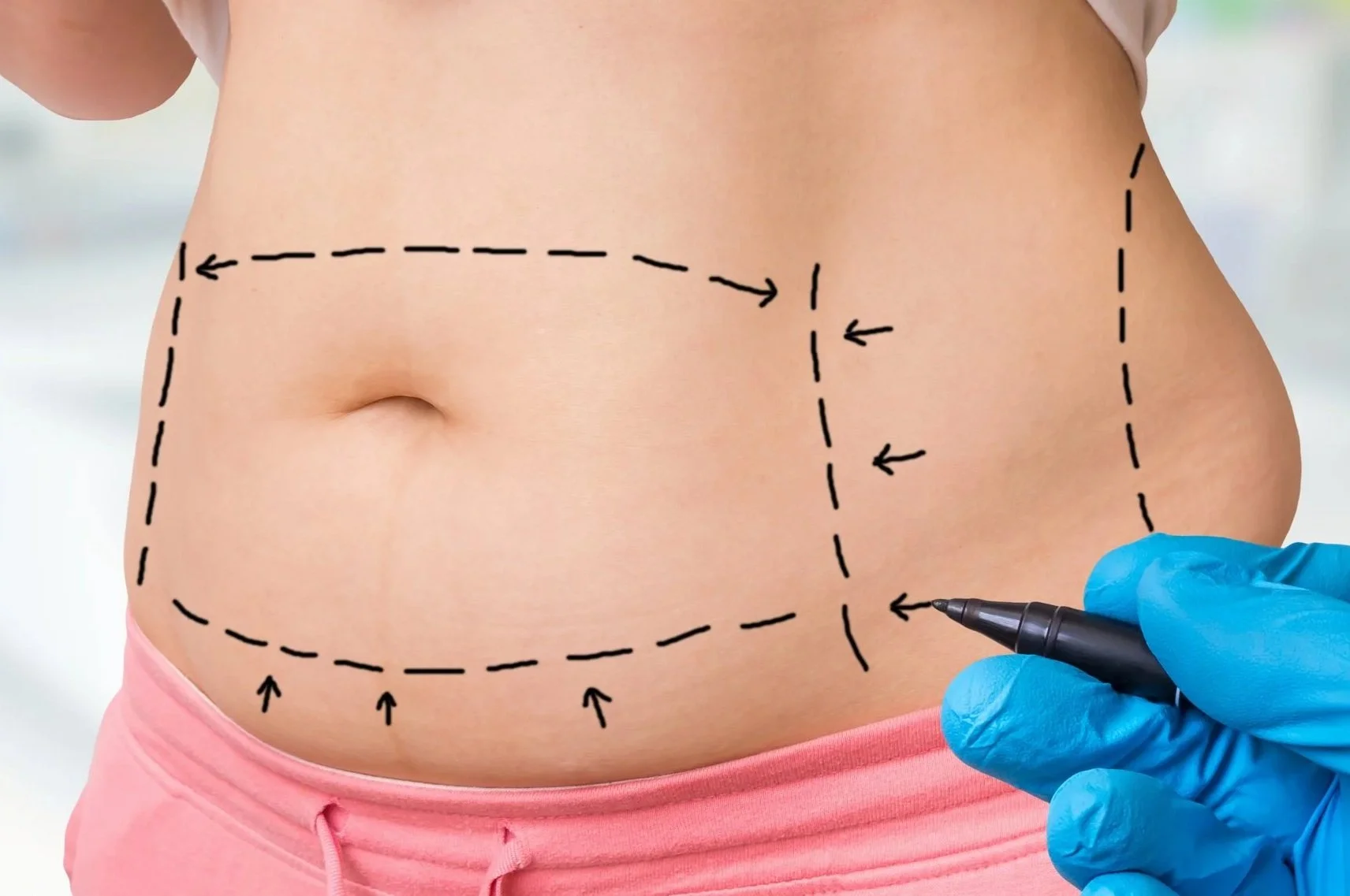 liposuction