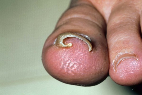 Ingrown nails, nails not grown properly 