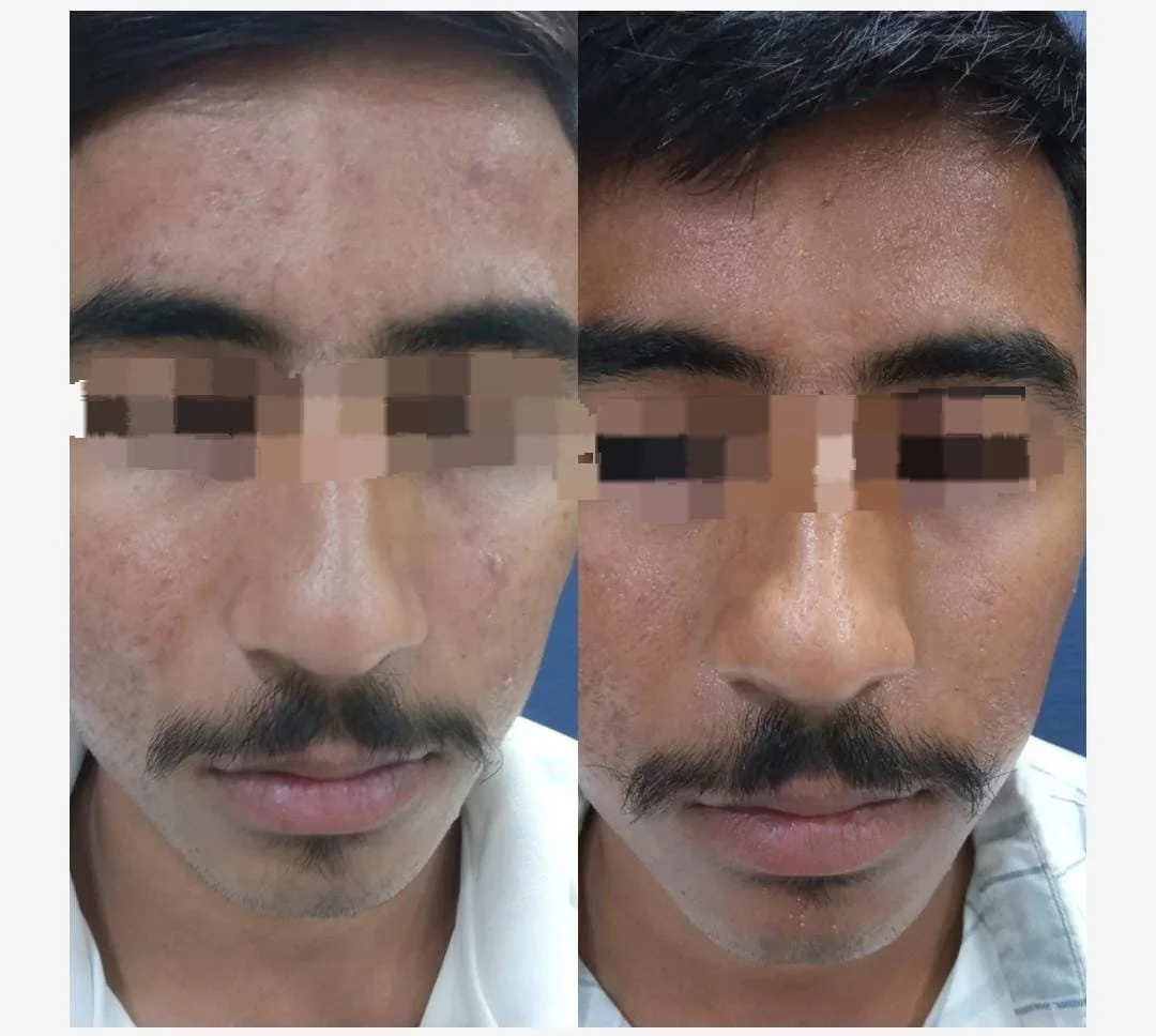 Acne Scars before and after treatment picture