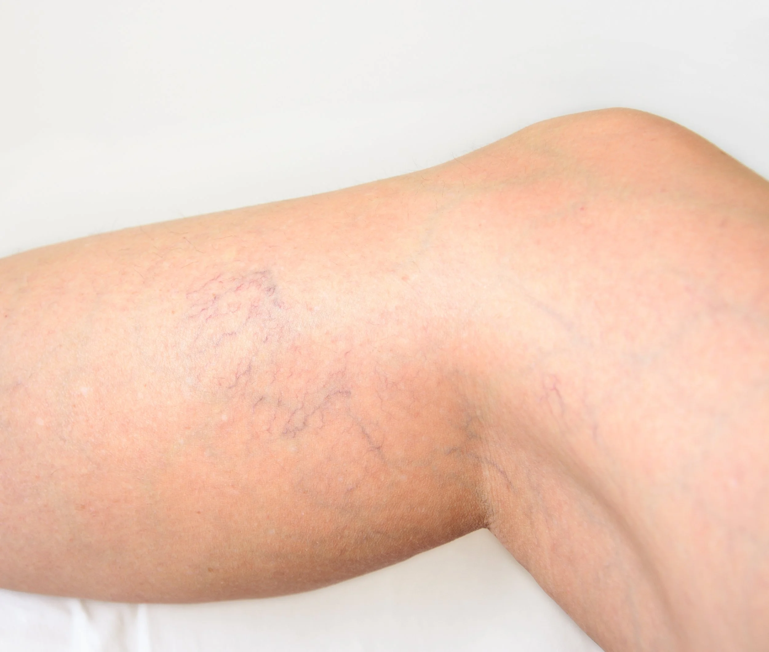 Spider veins or vericos veins