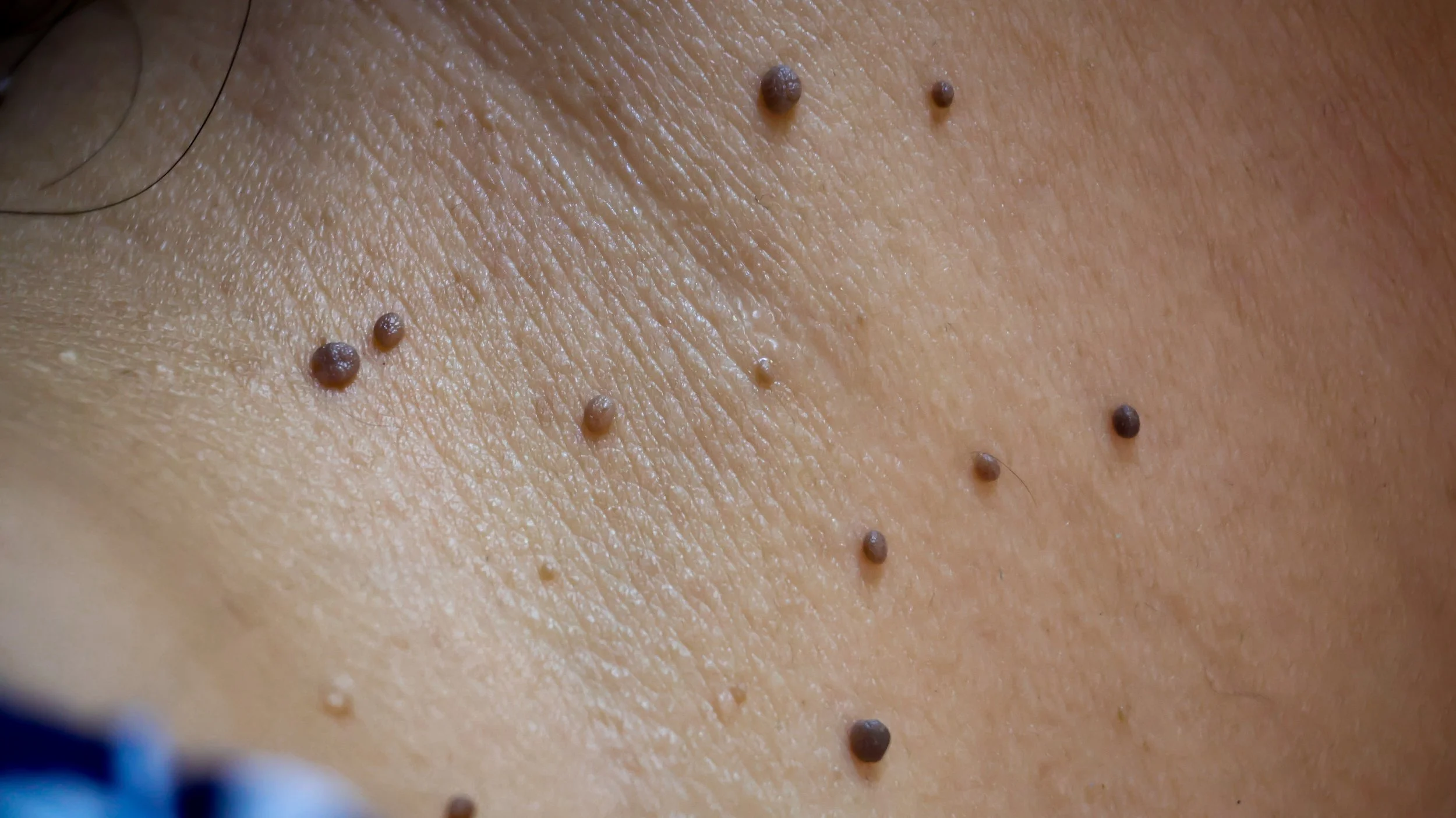 image showing skin tags, black rounded growth on the skin near neck region