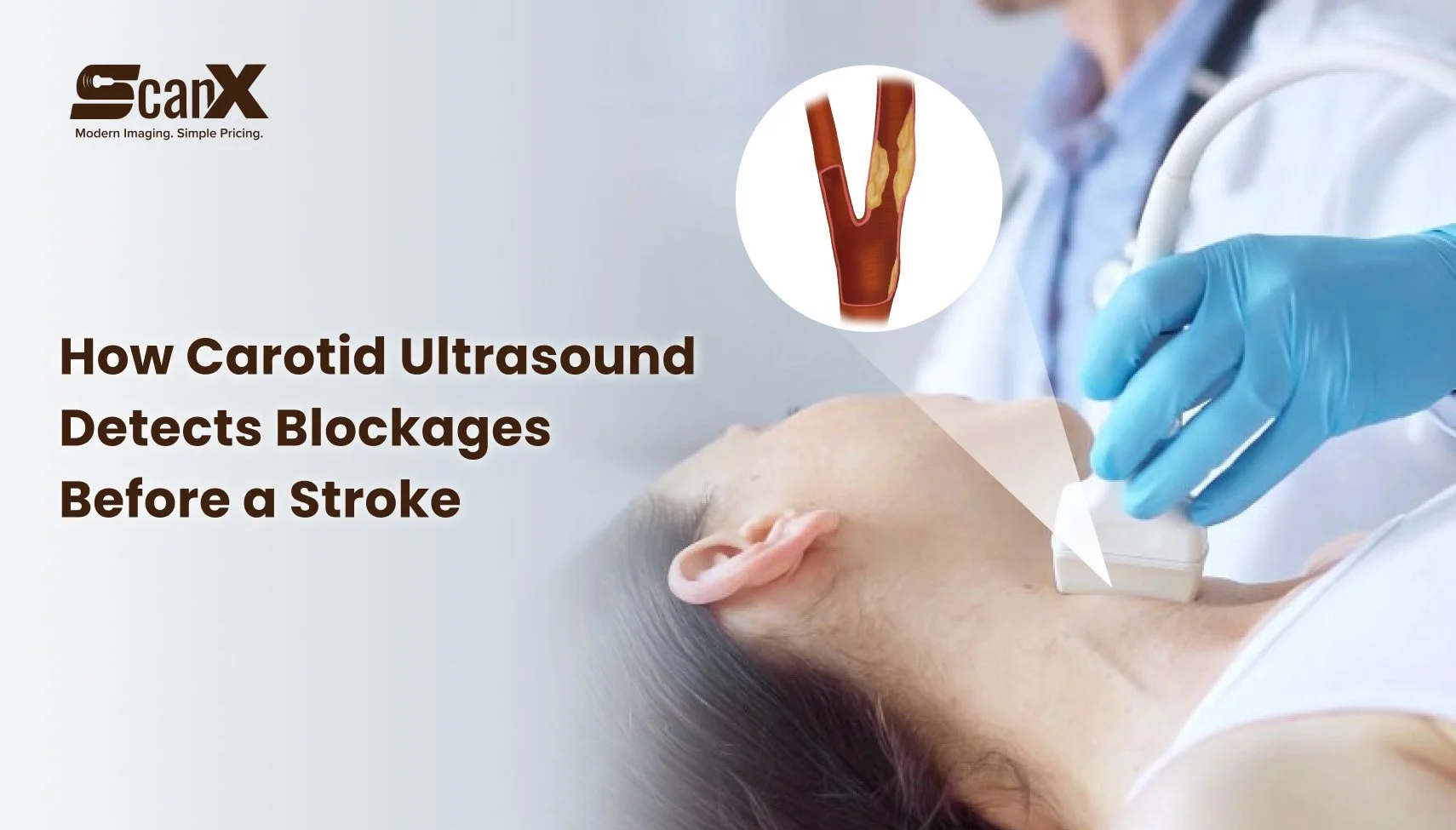 How Carotid Ultrasound Detects Blockages Before a Stroke