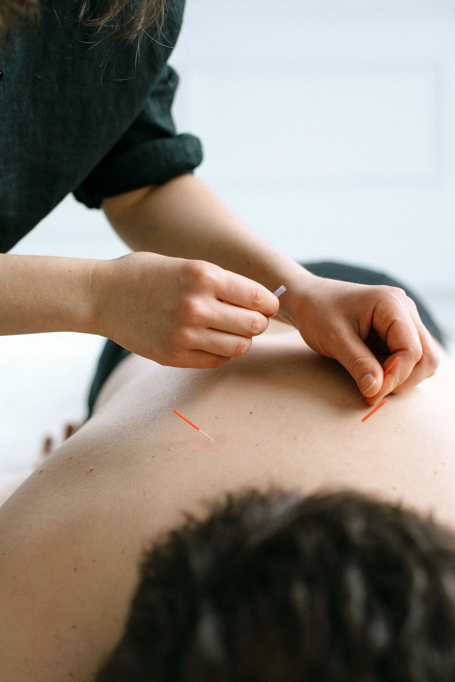 Acupuncturist inserting needles into a person's back during a treatment session.