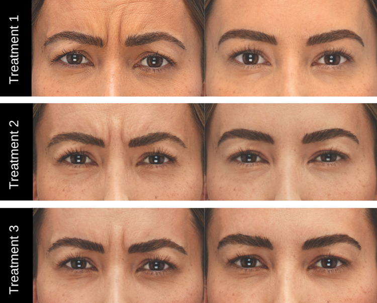 Botox Xeomin results 3