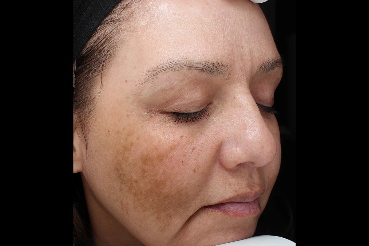 VI Peel before result