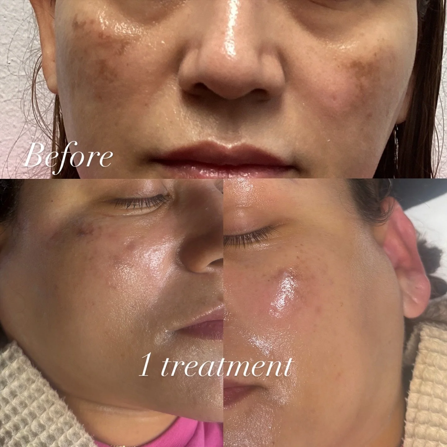 Performed by Kate, RN ✨ ➡️ IPL Photofacial &mdash; the glow that speaks for itself.
One session in, and the deeper brown clusters are already softer, lighter, and more diffused.
This is where true correction begins.

What to expect:
&bull; Spots may 