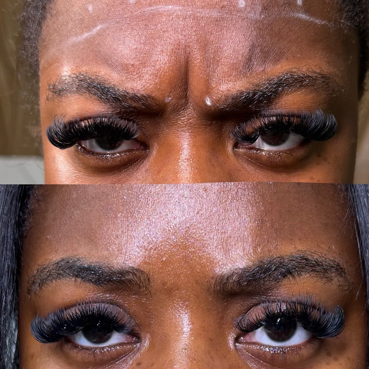 Before &amp; After: Glabella (11s) 💉✨

These lines form from repeated contraction of the corrugator and procerus muscles &mdash; the muscles responsible for frowning and squinting.

✨ What #Botox does:
&bull; Relaxes overactive muscles
&bull; Soften