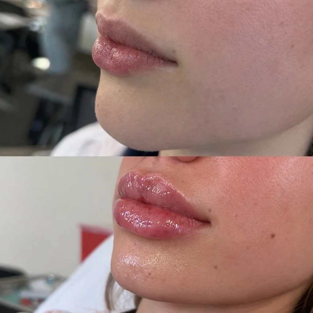 Lips ✨ Height without over-projection.
Soft vertical lift with no forward jut.
Defined yet natural vermillion borders, balanced upper-to-lower proportions, and a subtle central keyhole 
Kate, RN