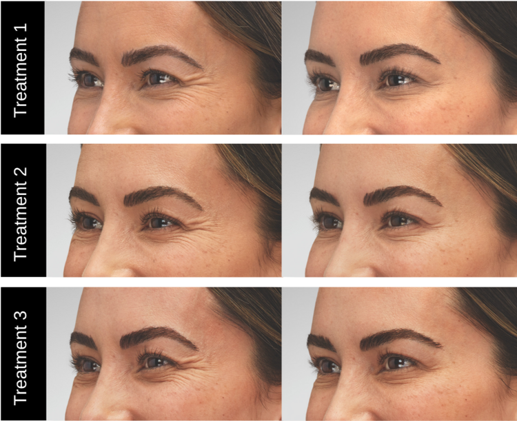 Botox Xeomin results 2