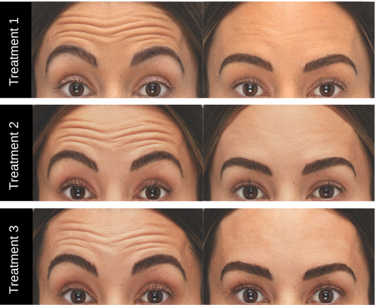 Botox Xeomin results 1