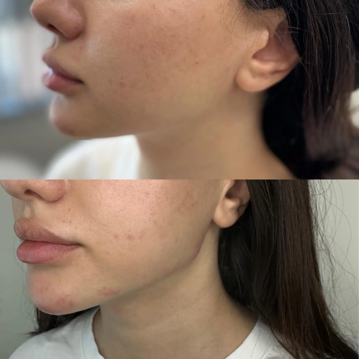 Jawline correction 💉💉💉