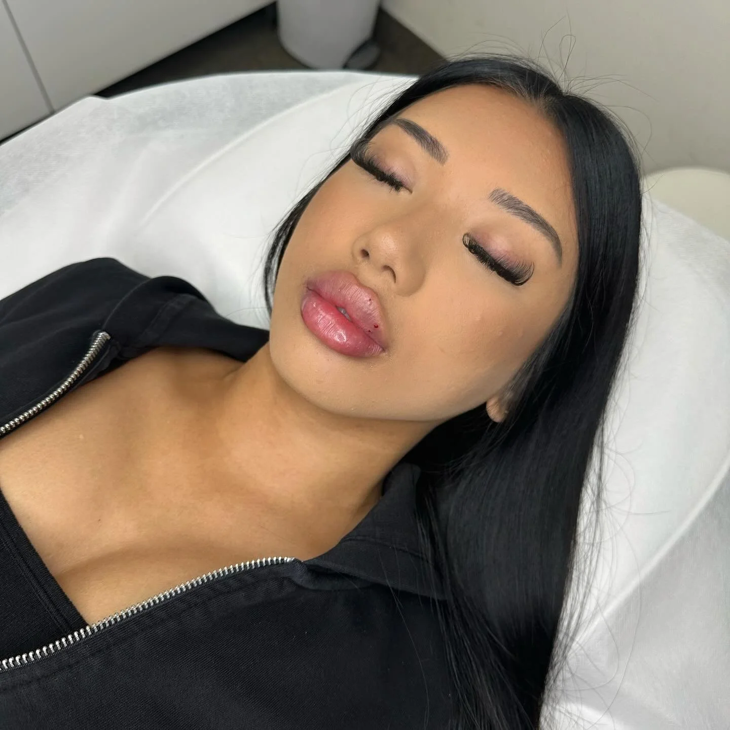 Lips Injection 💉💉💉
1 syringe Juvederm 
For information DM💌