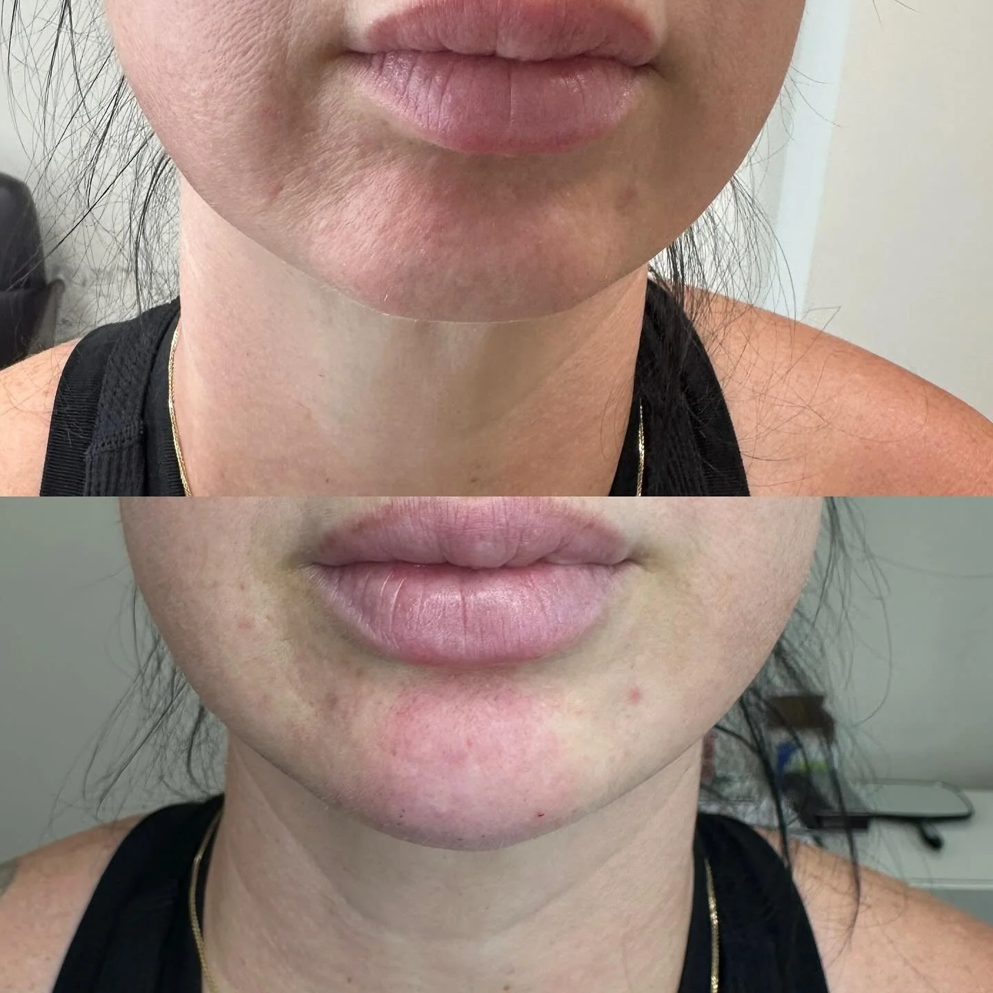 Chin correction 💉💉💉