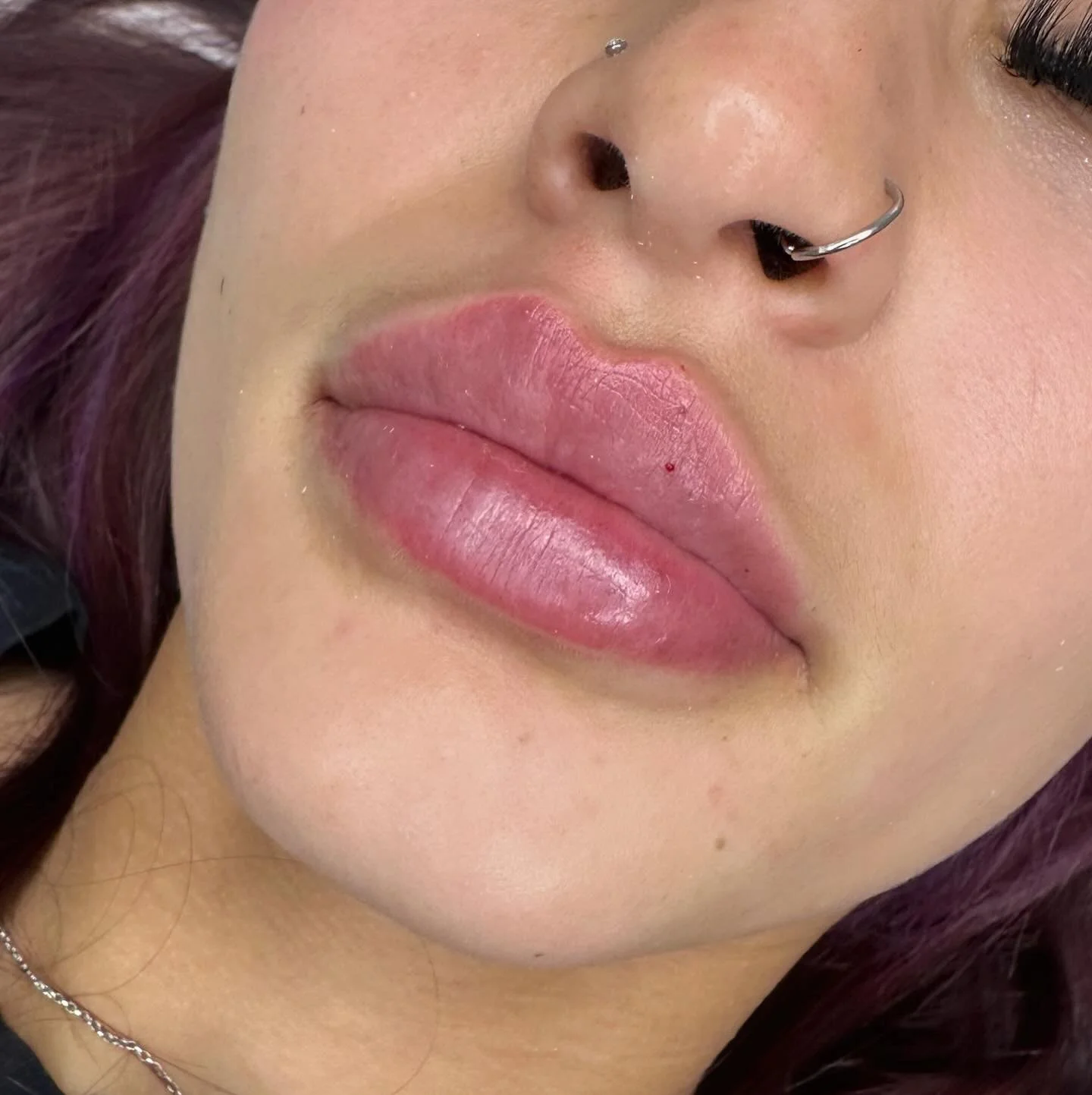 Lip Injection💉💉💉
1 syringe Juvederm Volbella 
For more information DM!