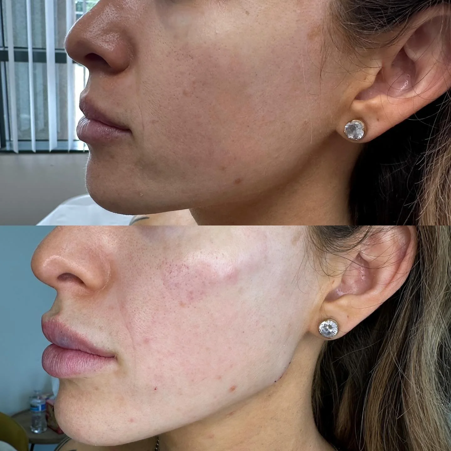 Jawline, Chin, Cheekbones correction ..!
#facialbalancing