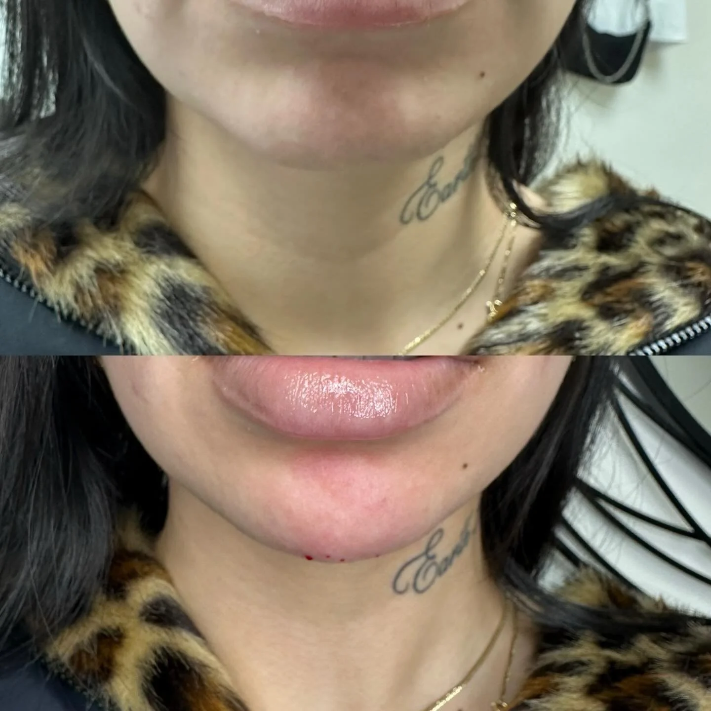 Chin correction 💉💉💉