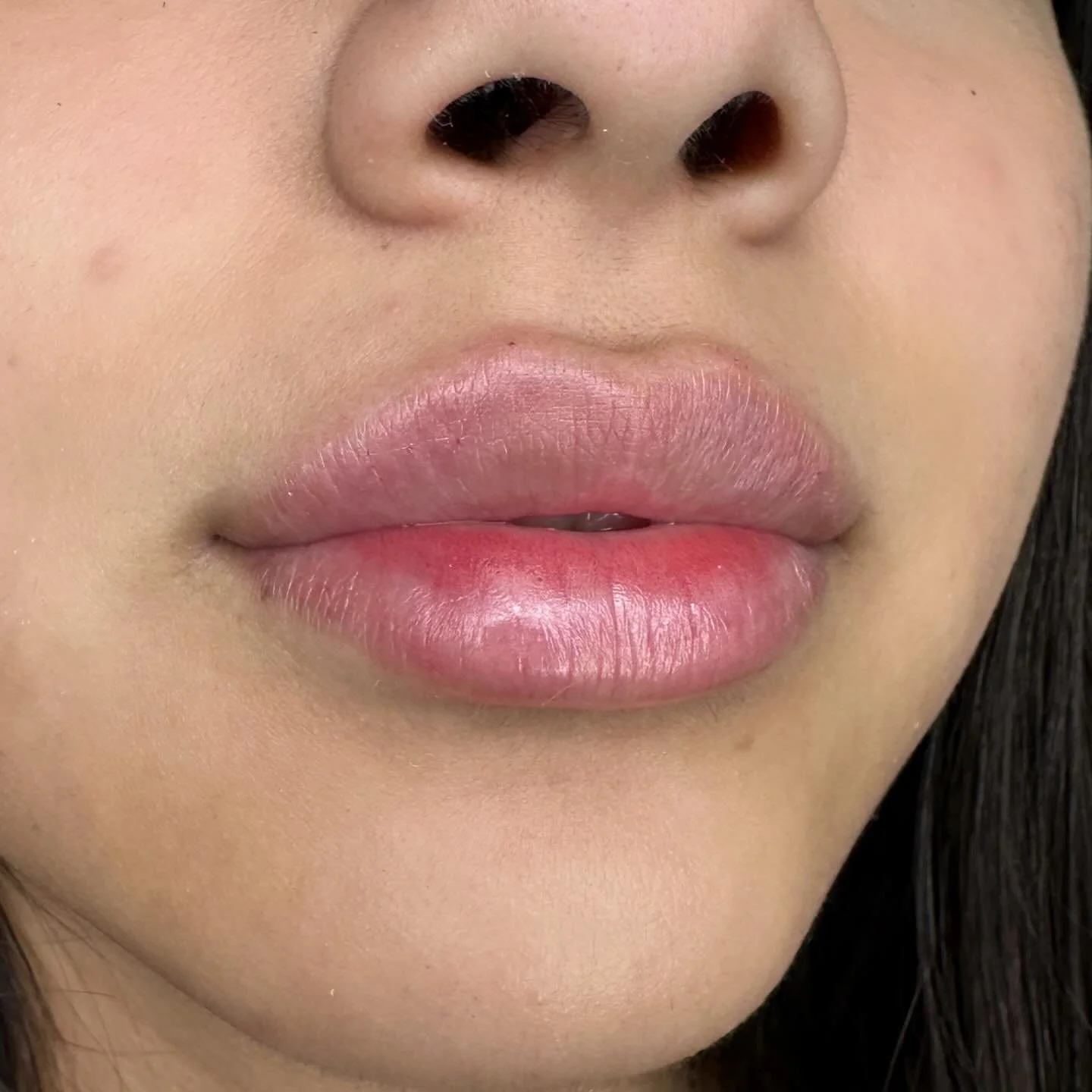 Lips augmentation 
Filler Juvederm Volbella 
For more information DM💌