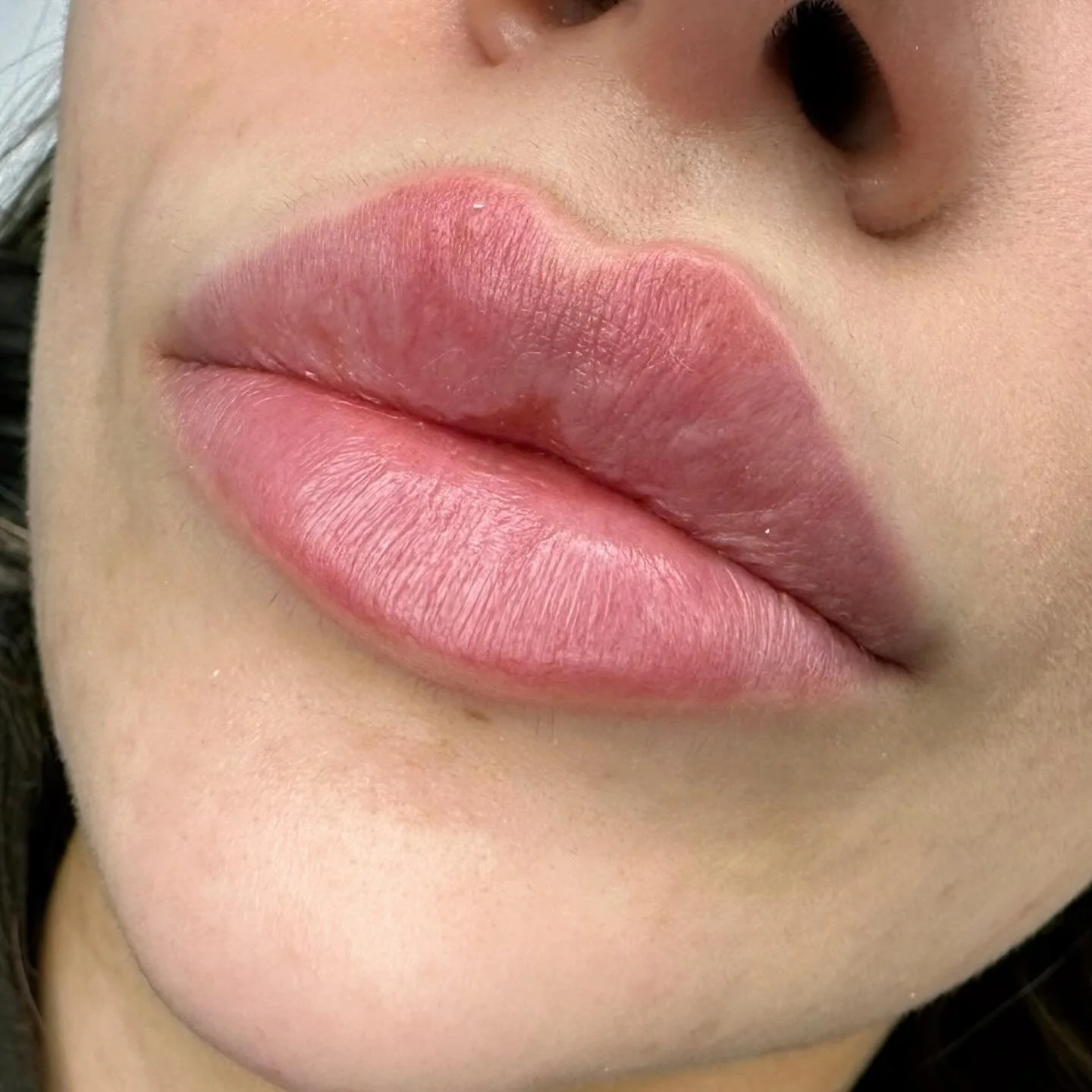 Lip filler 🤍
1 syringe Juvederm Volbella 
For more information DM💌