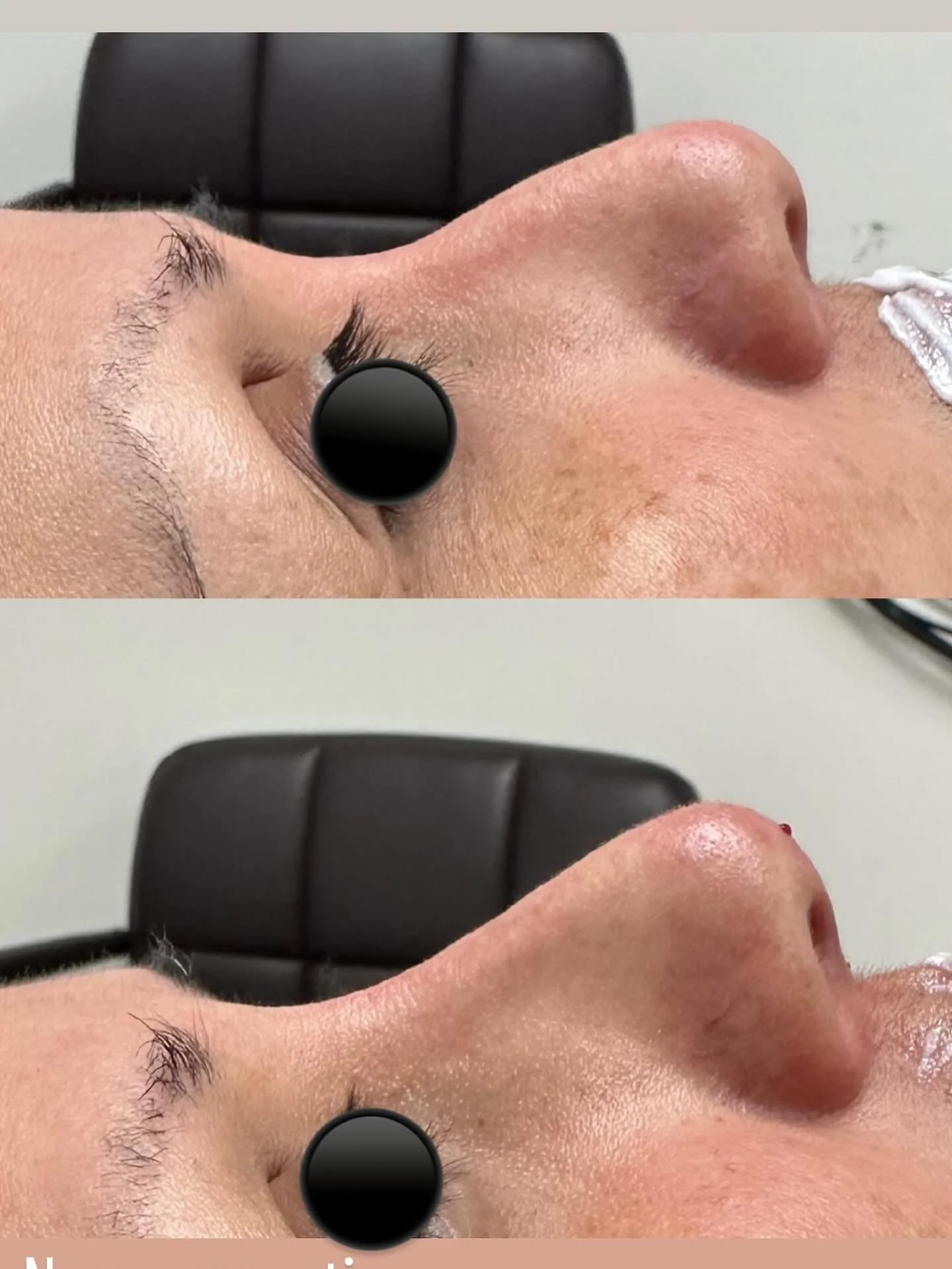 Nose correction 💉💉💉