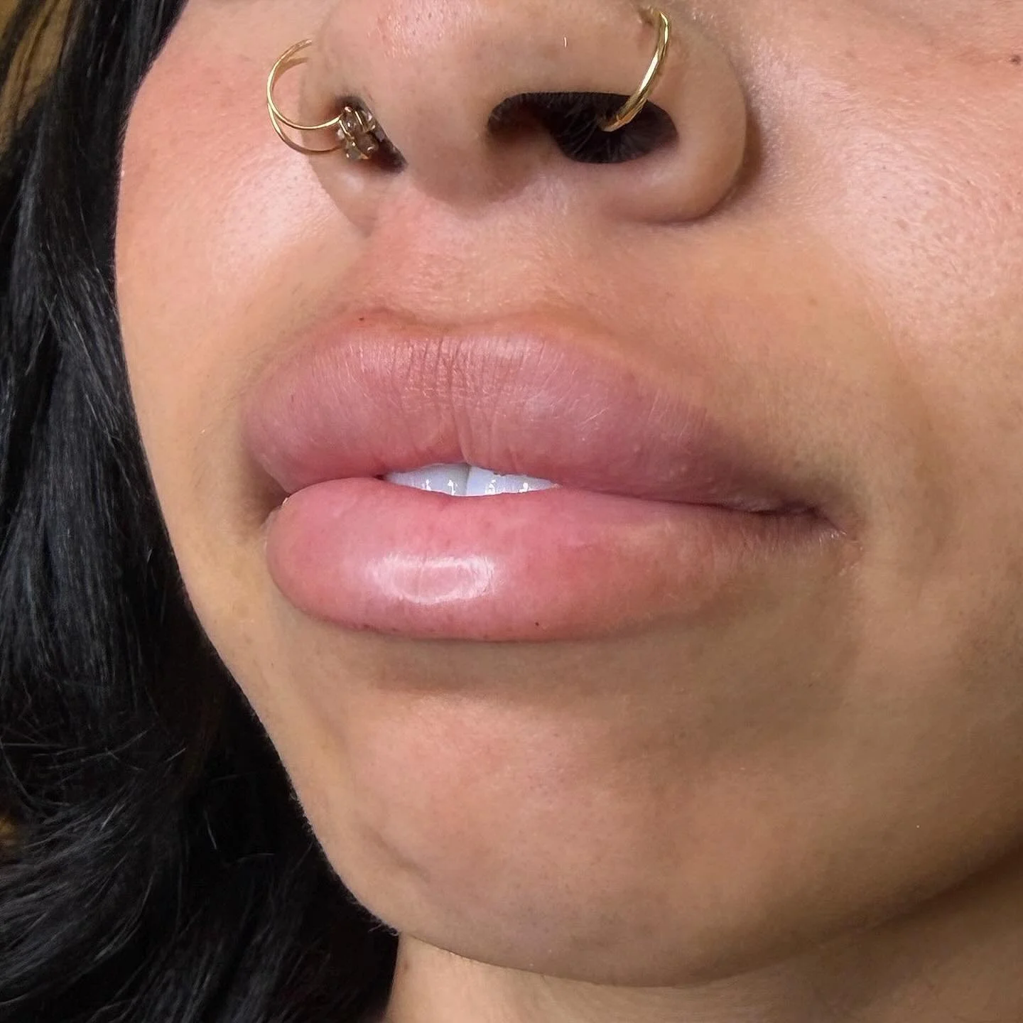💋 1 syringe lip filler &mdash; just $350 💉
Natural, full lips ✨ Quick treatment, minimal downtime
Safe injections | Expert injector | Before &amp; after
📍 Los Angeles
DM &lsquo;LIPS&rsquo; to book your appointment 💌
#lipfiller #1syringe #naturall