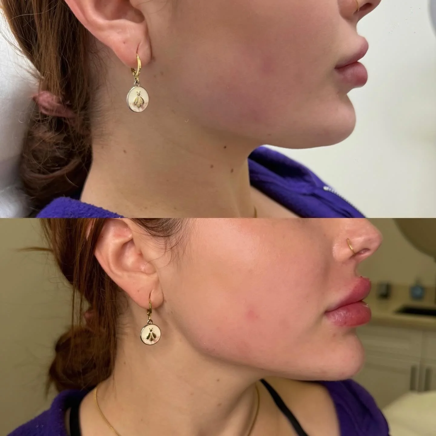 Jawline correction 💉💉💉
For information DM or 📞7473086416