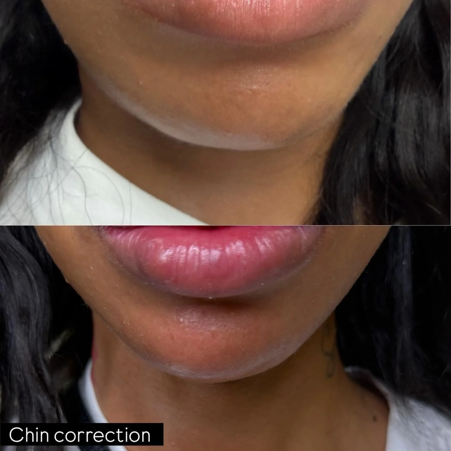 1 syringe of chin filler.
For appointment SkinnLoft.com
Or 📞7473086416