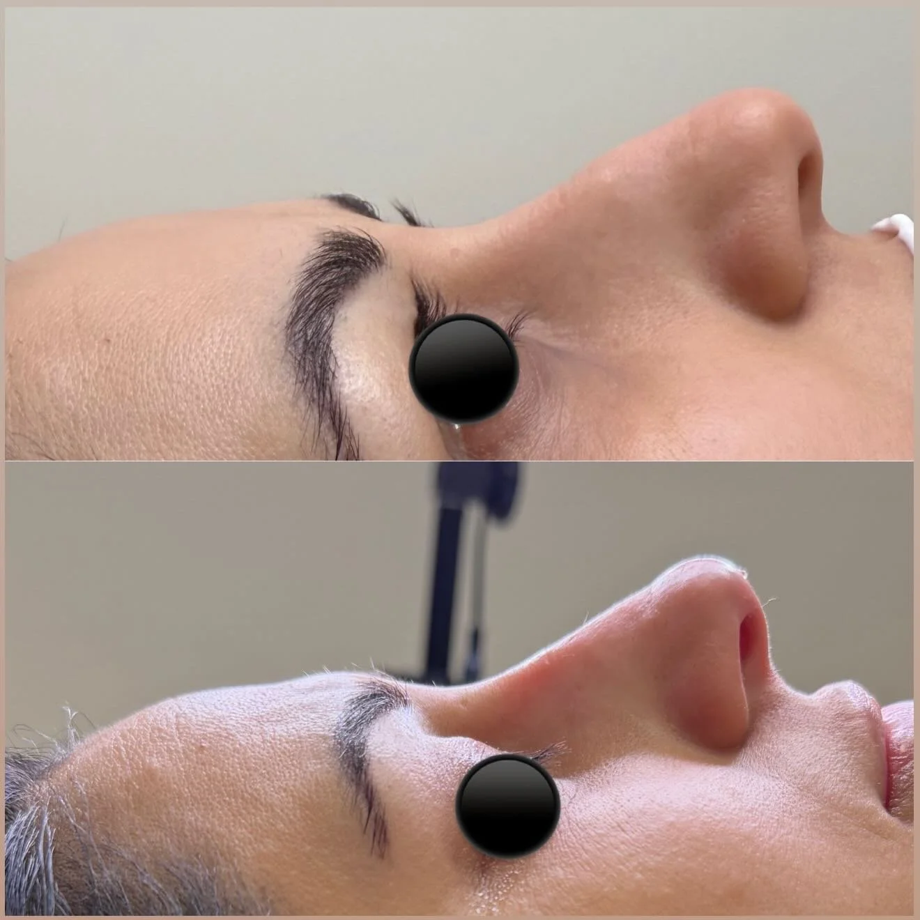 Nose correction 
For mor information DM💌