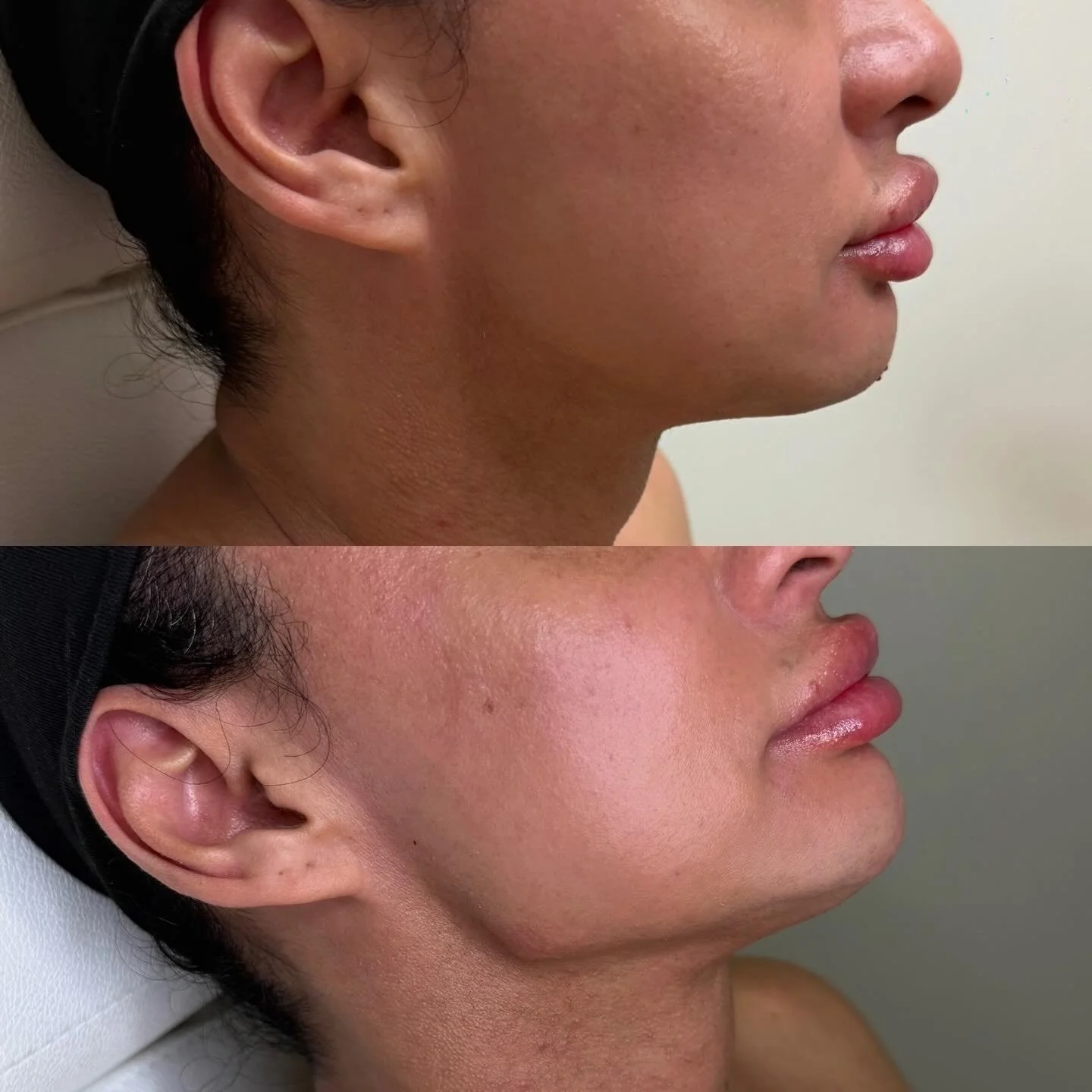Jawline correction 
For appointment SkinnLoft.com