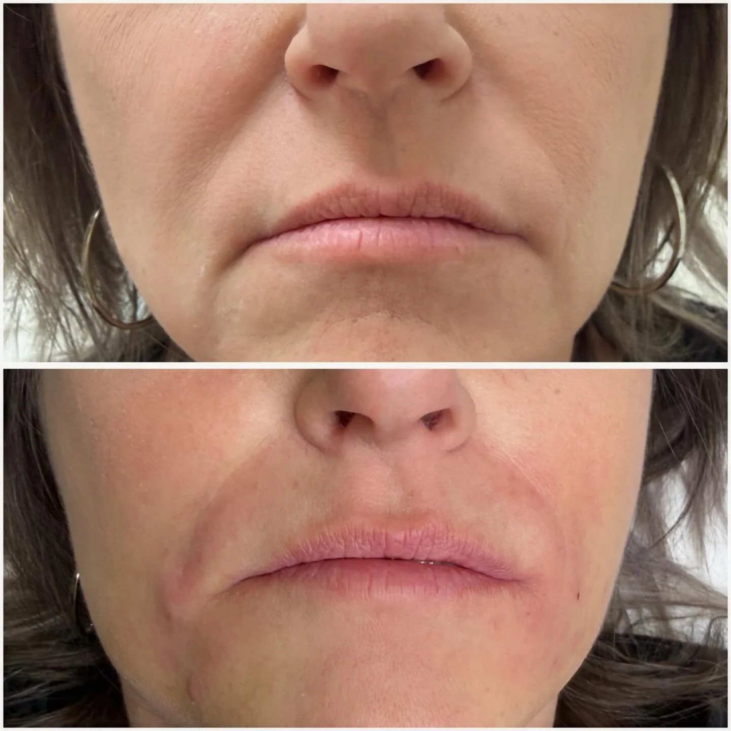 Smile lines correction 💉💉💉