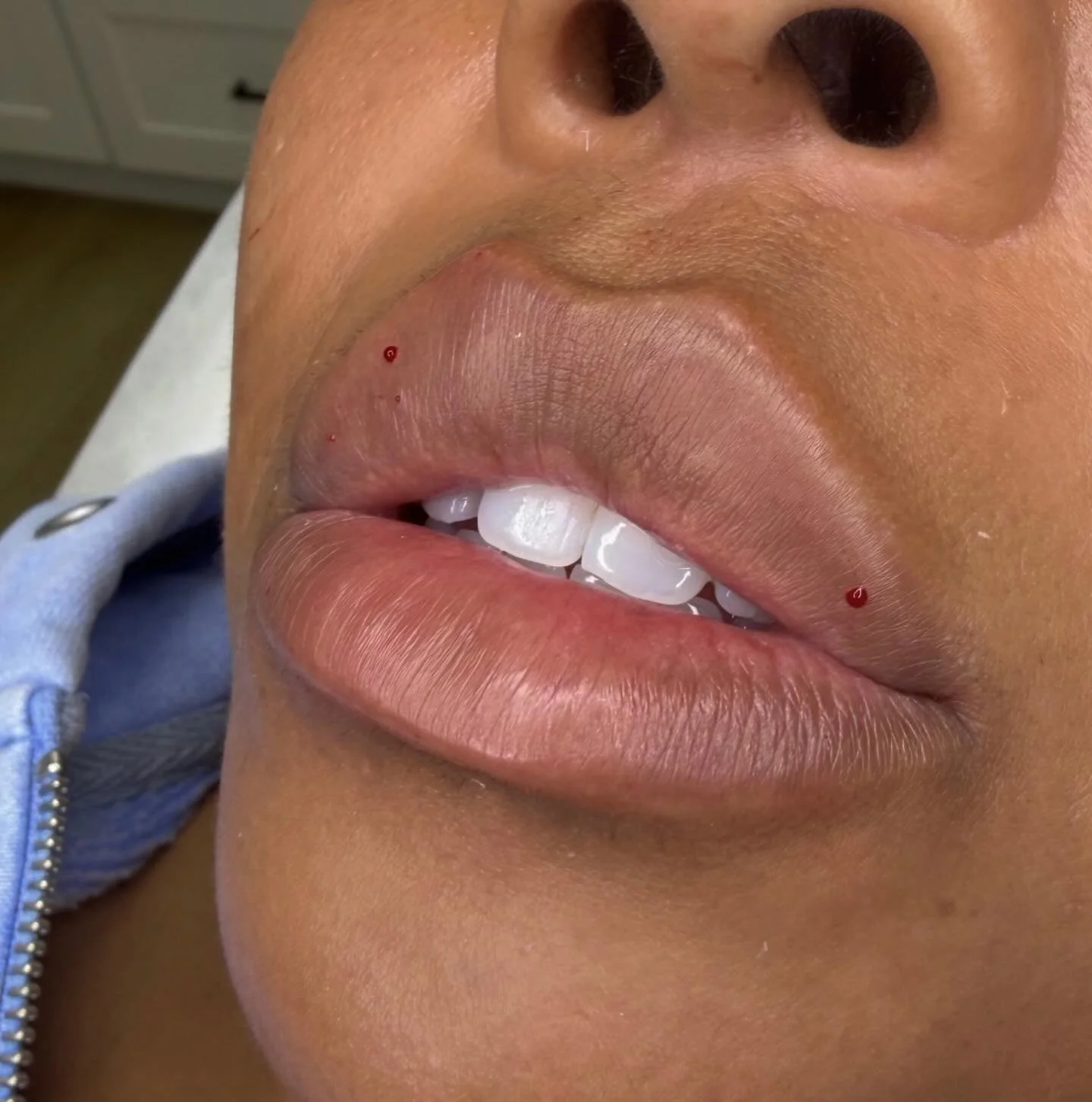 Lip filler
1 syringe started from 350$
For appointment 📞7473086416
Or SkinnLoft.com