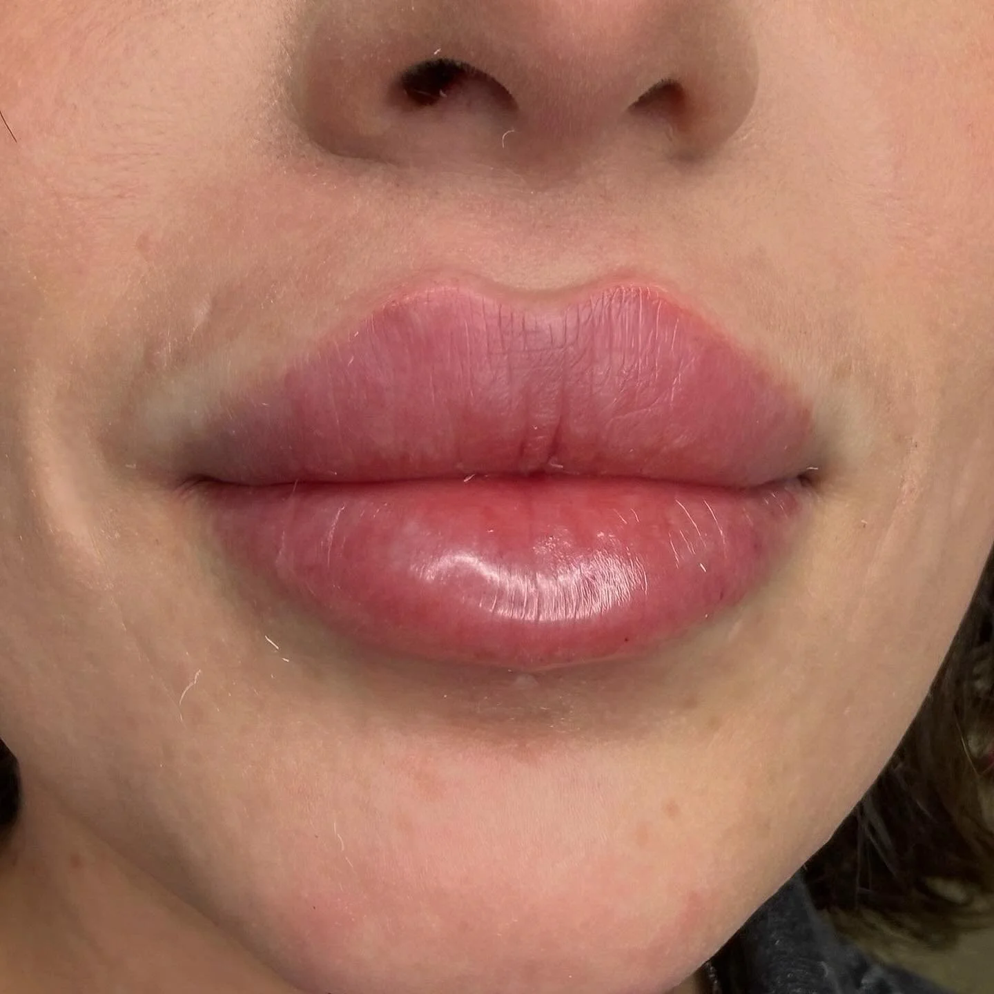 Lip filler
1 syringe started from 350$
For appointment 📞7473086416
Or SkinnLoft.com