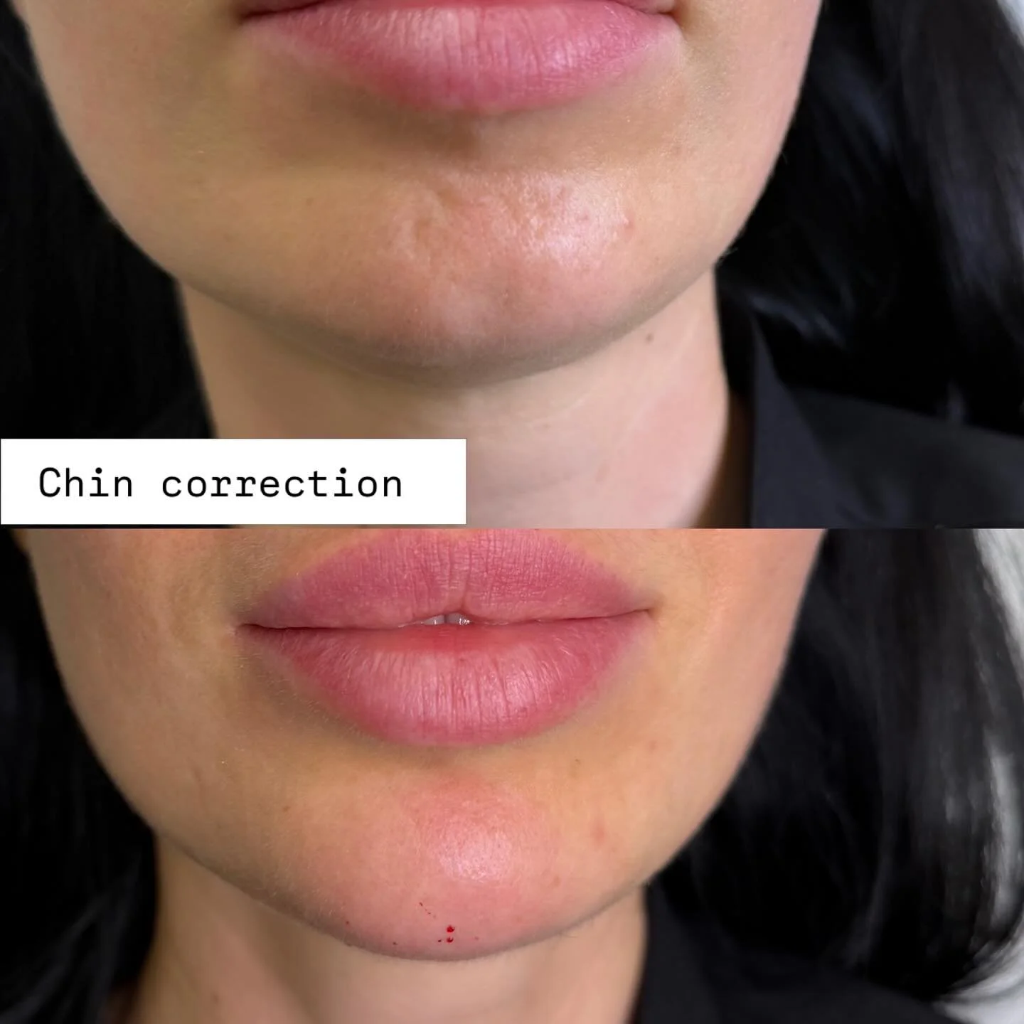 Chin correction with filler enhances facial balance, improves profile, and creates a more defined, sculpted look with natural results and minimal downtime.

#ChinFiller #JawlineContour #FacialBalance #NonSurgical #aestheticresults