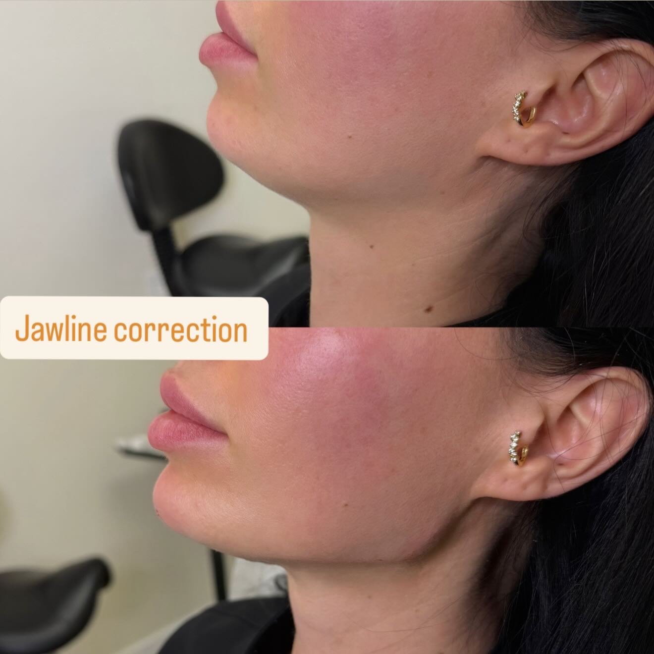 Jawline correction 
3 syringe filler
For more information DM or 📞7473086416