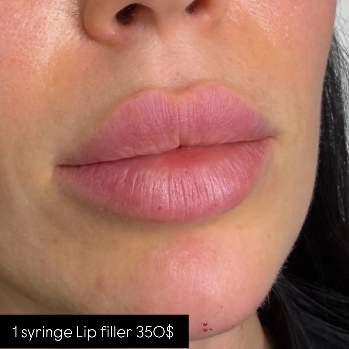 #Lips💉💉💉
1 syringe started from 350$
For appointment call us 📞7473086416 or book online SkinnLoft.com
