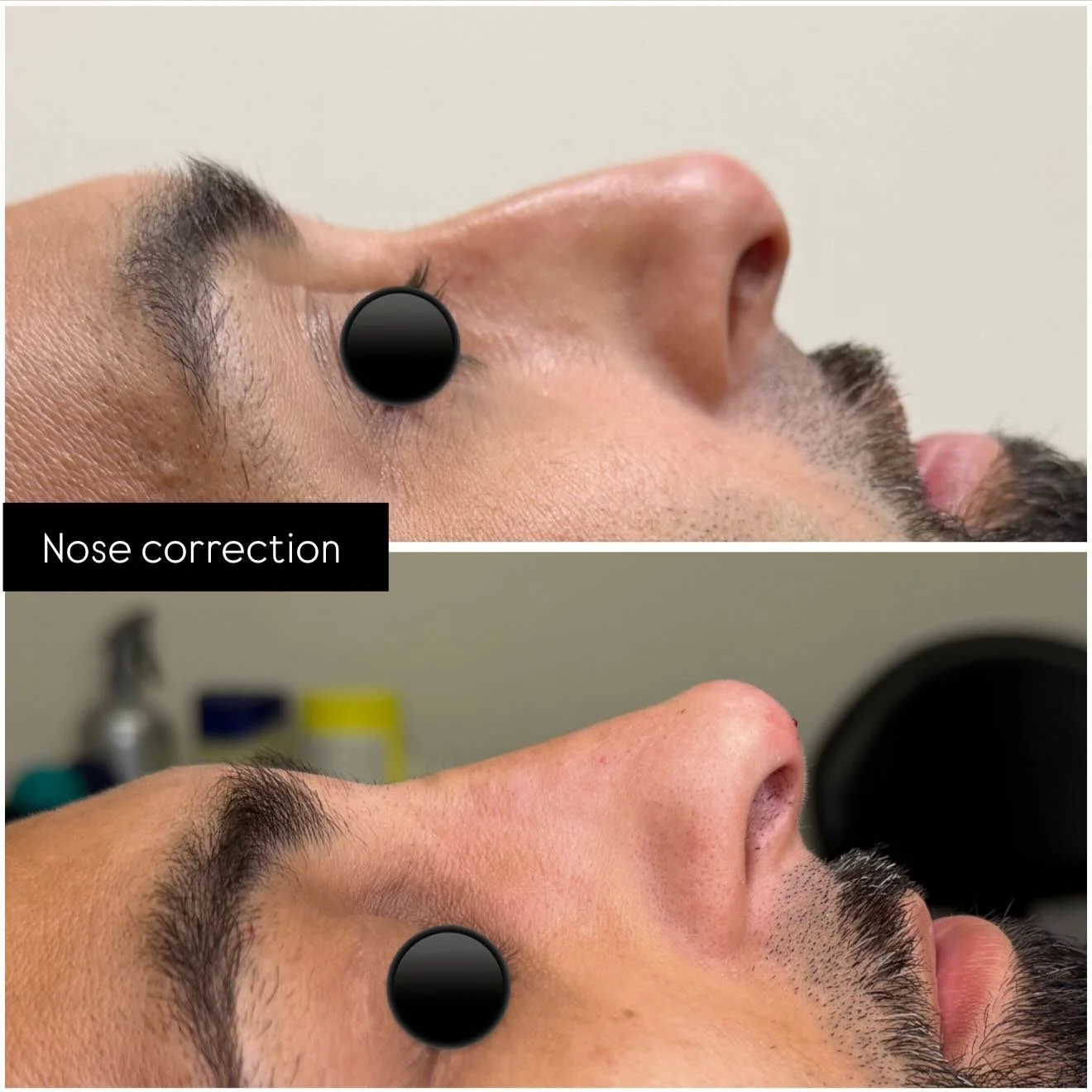 Non surgical rhinoplasty 💉💉💉
For appointment SkinnLoft.com or 📞7473086416