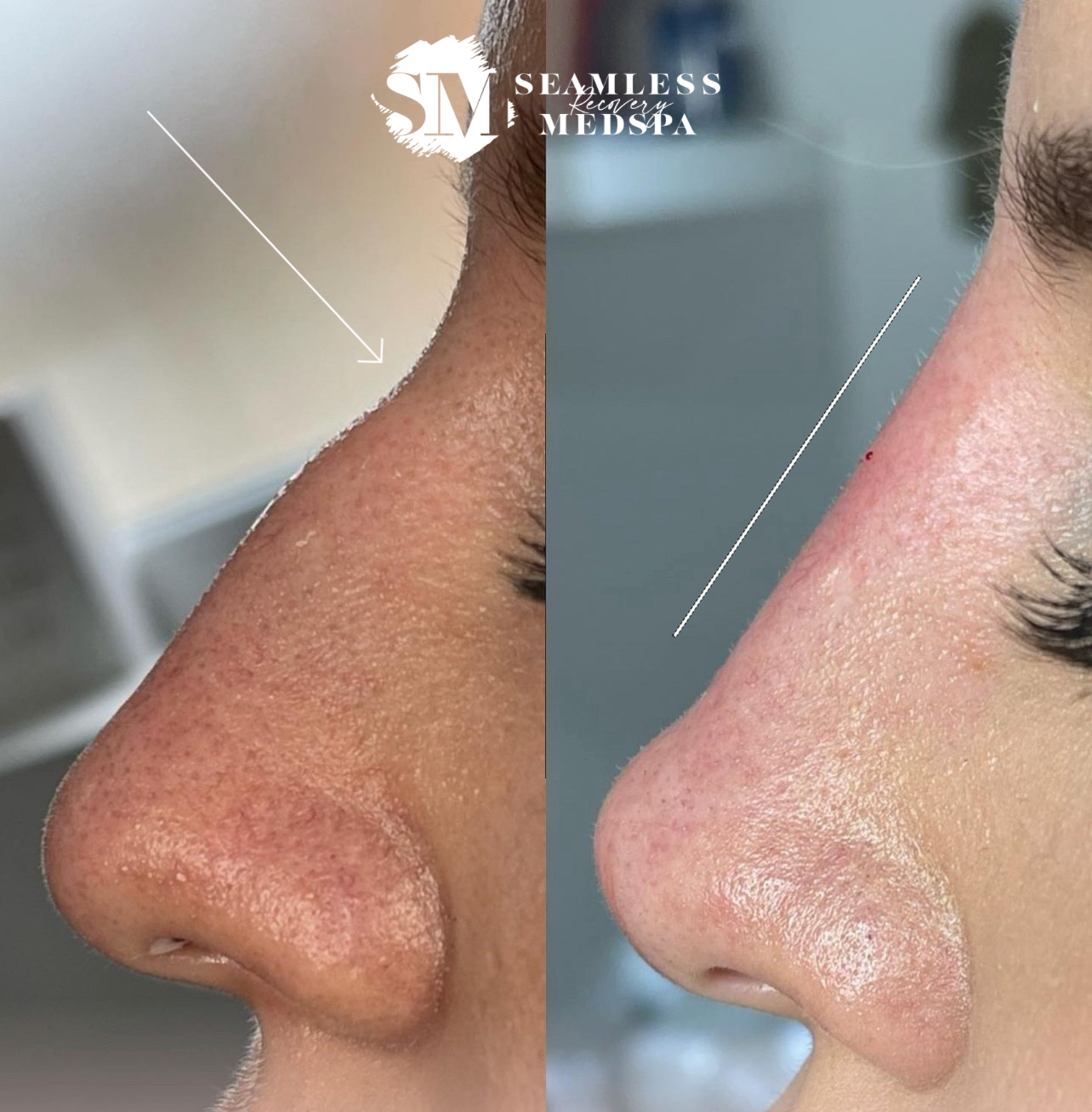 Non-Surgical Rhinoplasty (1).png