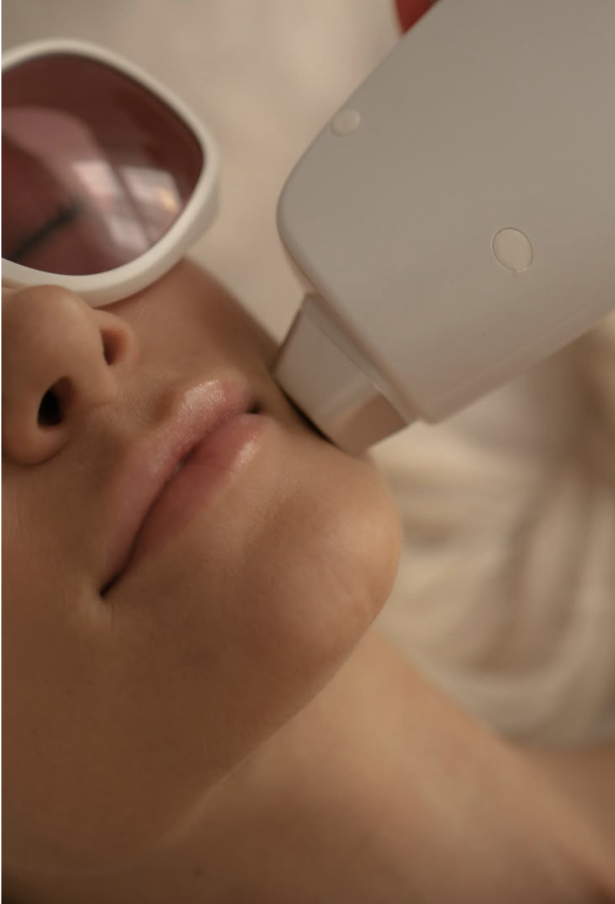 L'épilation laser en toute précision