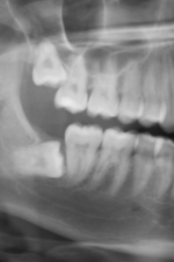 Third Molar Surgical Extraction
