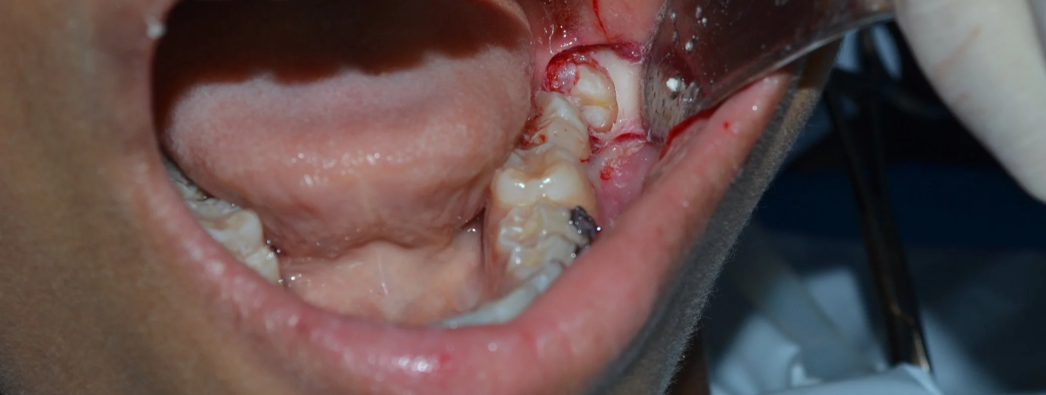 Close-up of a patient's open mouth during dental surgery, revealing teeth and gums with some bleeding, with dental tools in use.