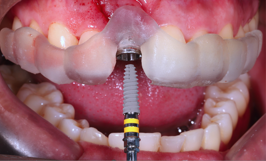 Dental Implantology