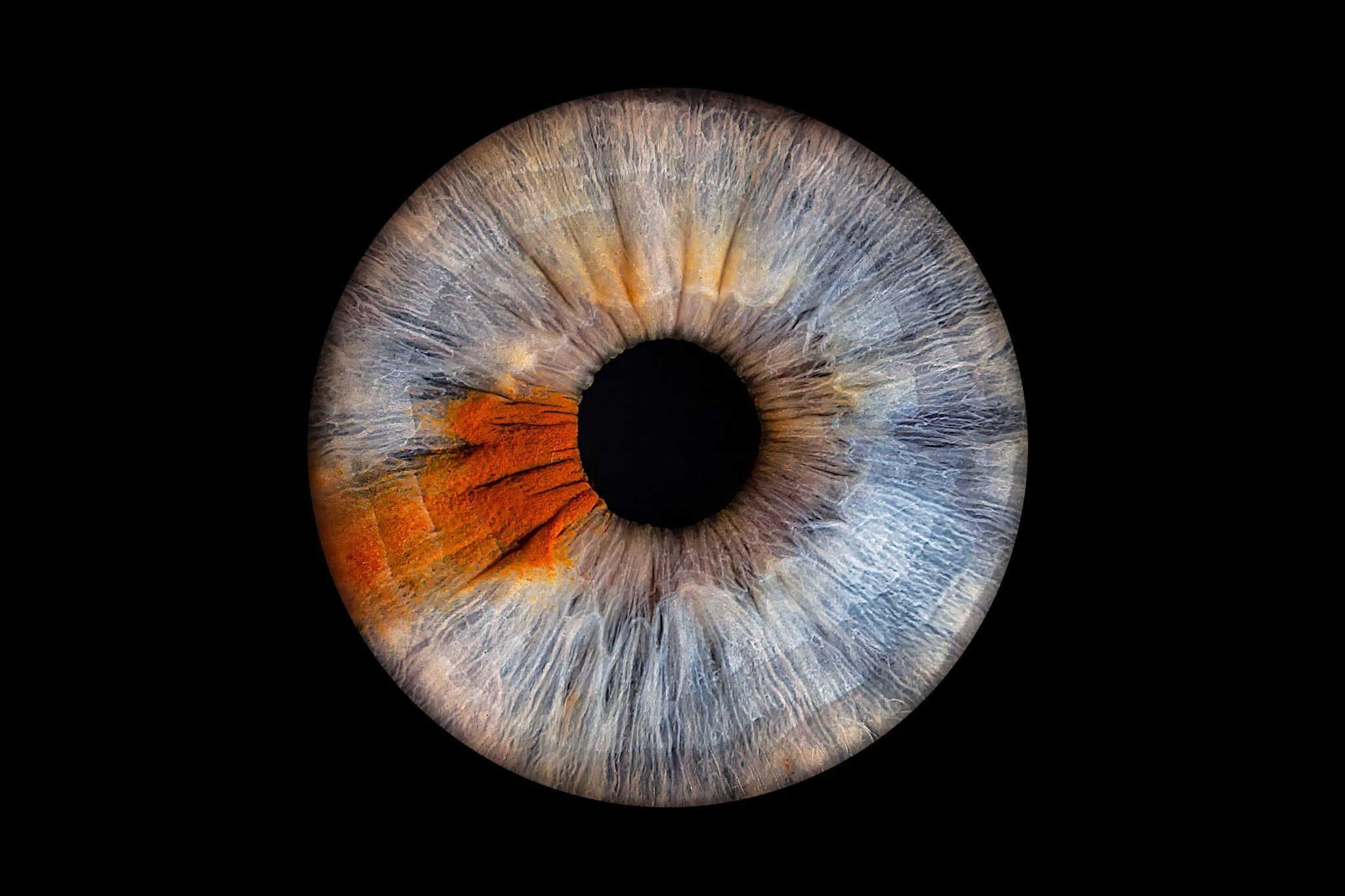 Heterochromia-blue-brown-iris.jpg