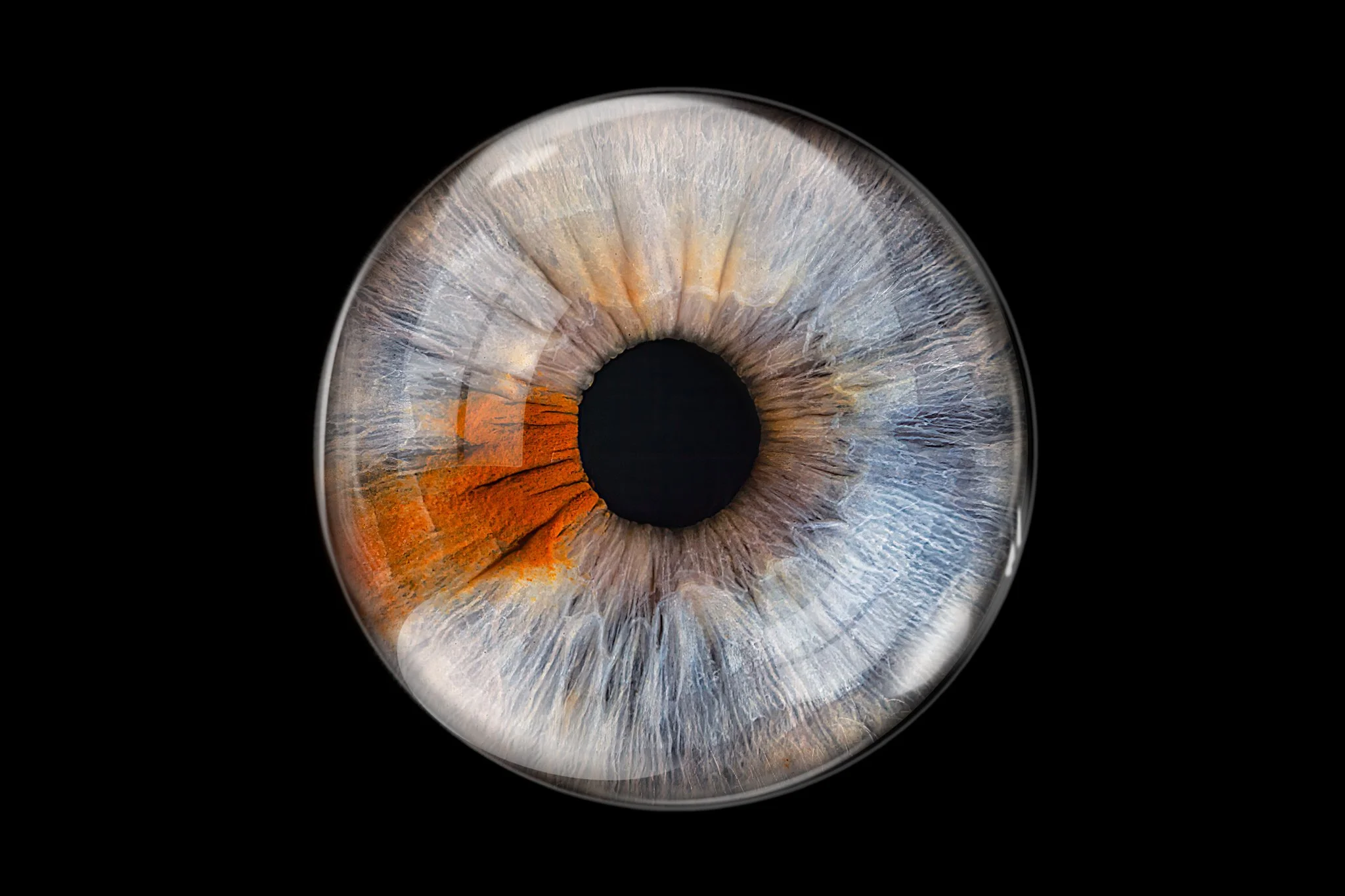 Heterochromia-blue-brown-iris.with-glass-overlay.jpg