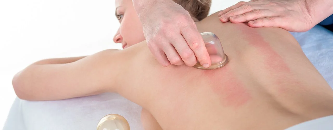 Cupping Therapy